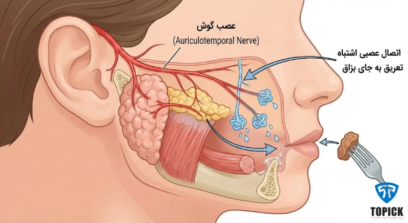 سندرم فری از دلایل تعریق هنگام غذا خوردن
