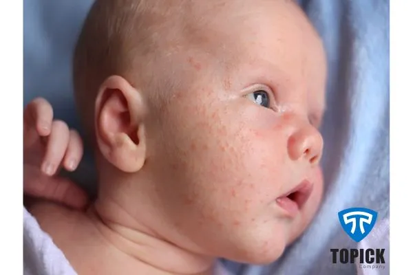 عرق کردن زیاد نوزاد در خواب