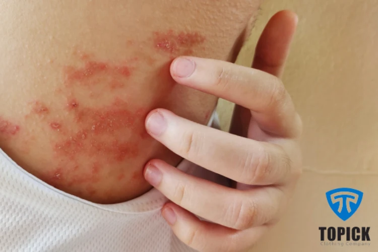 حساسیت پوستی از عوارض ضد تعریق ها 